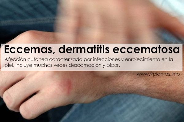 Eccemas, eczema, dermatitis eccematosa