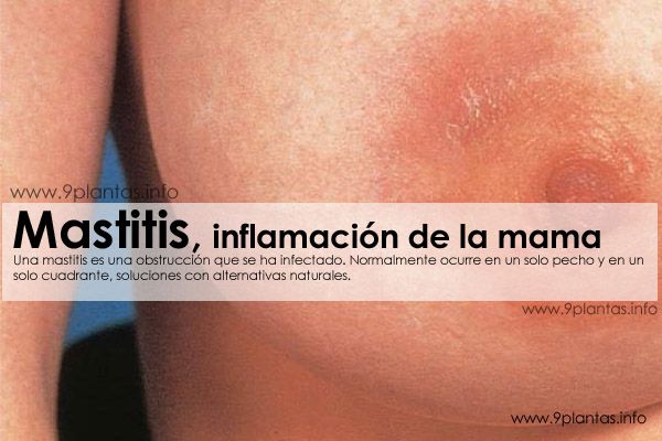 Mastitis, inflamación de mamas